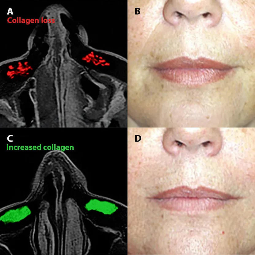 Micro-Infusion System For Smile Lines PDRN + Copper Peptide + NAD⁺