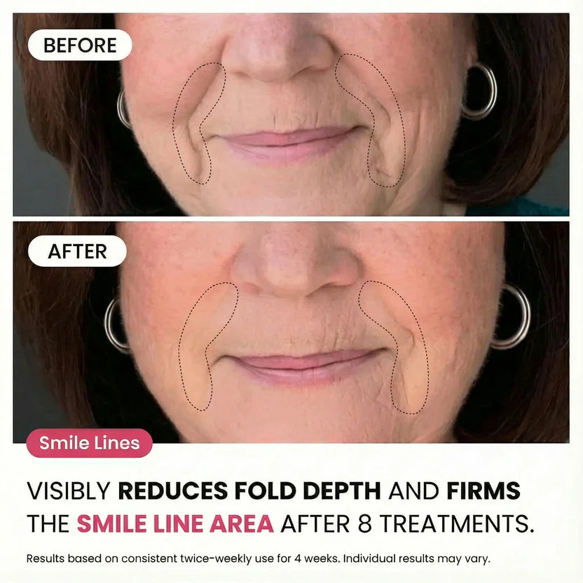 Micro-Infusion System For Smile Lines PDRN + Copper Peptide + NAD⁺